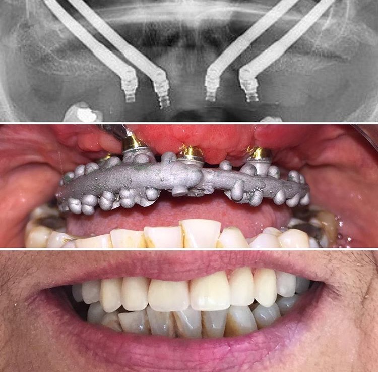 Implantes cigomáticos y rehabilitación dental