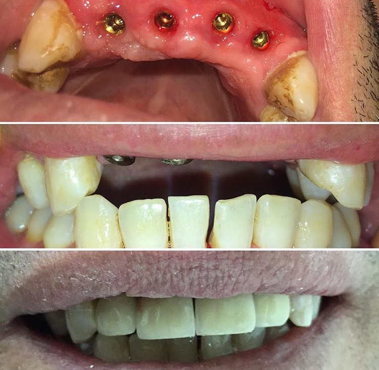 Implantes dentales y Rehabilitación sector anterior