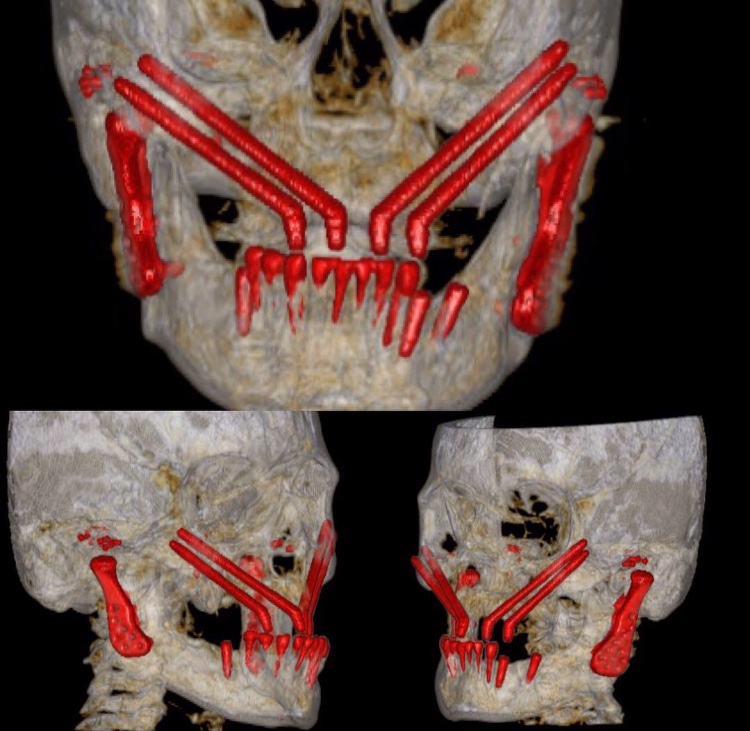 Reconstrucción facial compleja
