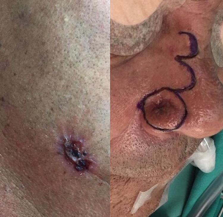 Cirugía Tumoral y biopsias de piel