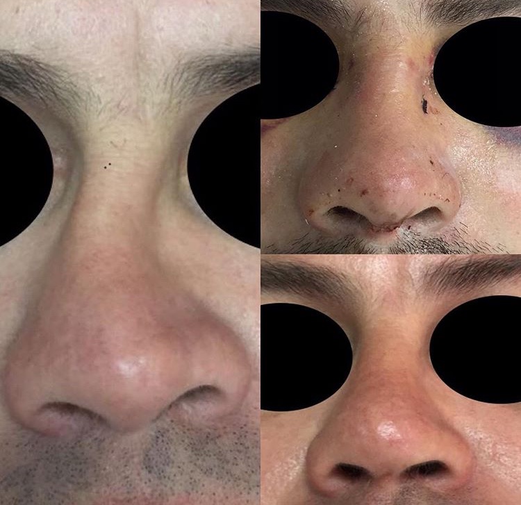 Cirugía nasal en trauma nasal antiguo