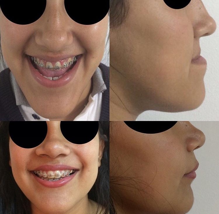 Cirugía Ortognática y Rinoplastia en conjunto