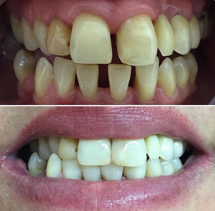 Cierre de diastema (espacio) dental con carillas (fundas)