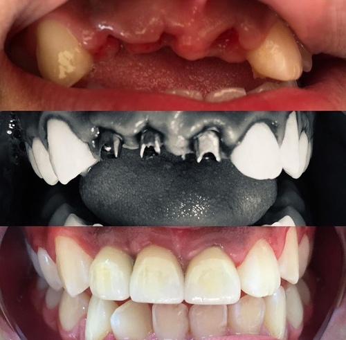 Cirugía Implantológica avanzada