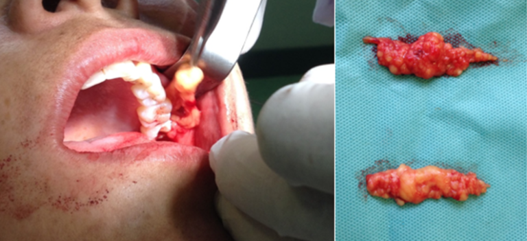 Bichectomia bilateral