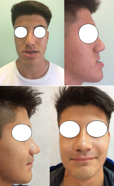 Clase III esqueltal operada mediante Cirugía Ortognática