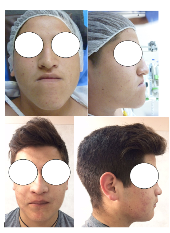 Corrección facial mediante cirugía Ortognática