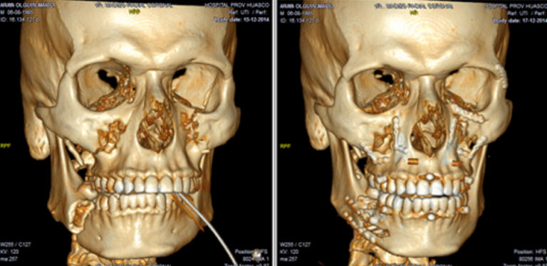 Trauma Facial complejo (Panfacial)