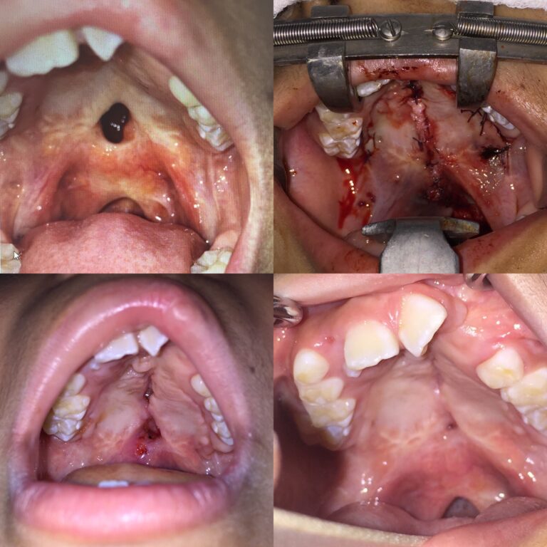 Cirugía de Paladar en pacientes con fisura labiopalatina. Técnica Asensio.