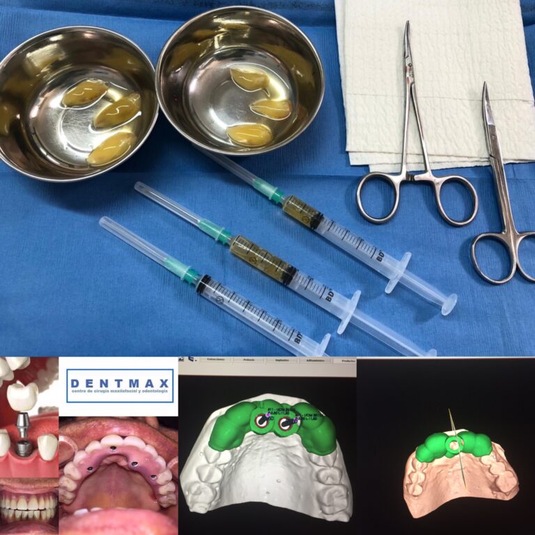 Cirugía implantes dentales con Plasma Rico en Fibrina y Programación virtual