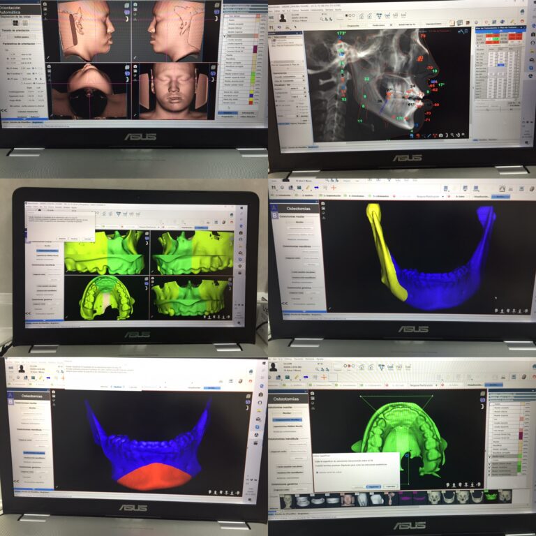 Programación virtual de cirugía Ortognática y de implantes dentarios