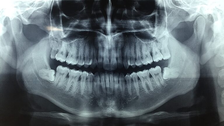 Cirugía de terceros molares o molares del juicio