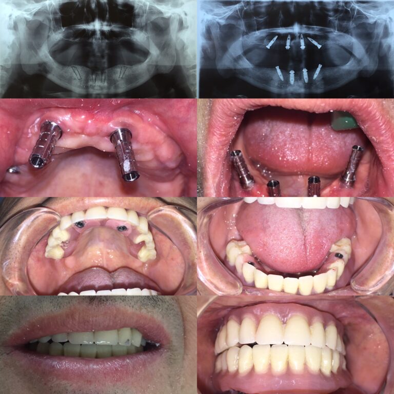 Implantes dentarios, injerto de hueso y Rehabilitación fija