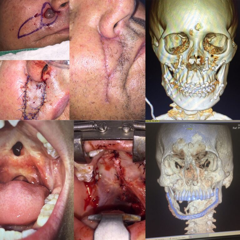 Cirugía de tumores faciales