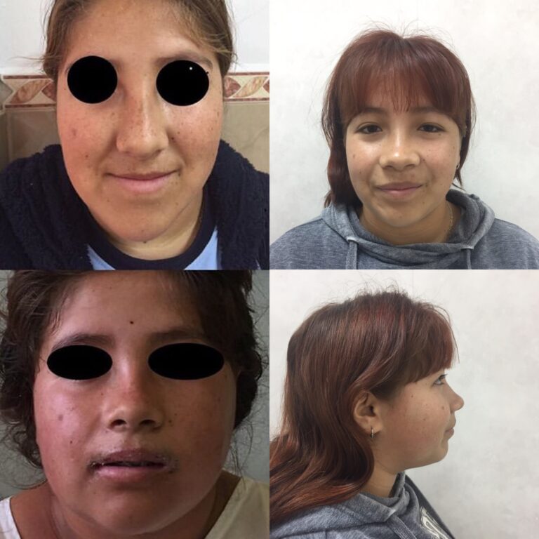 Cirugía Ortognática y rinoplastia en conjunto.