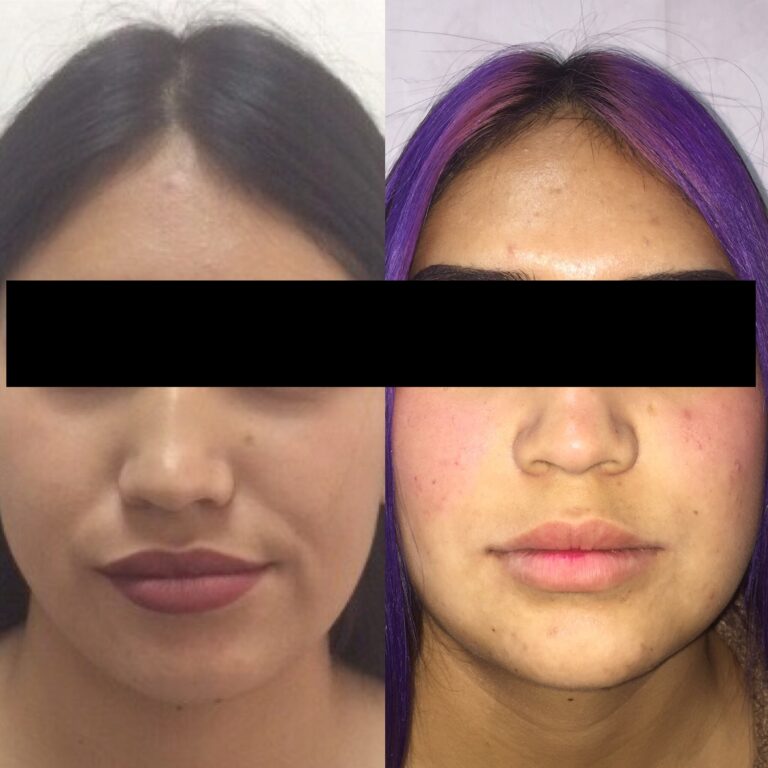 Cirugía Ortognática en Asimetría de mandíbula por Hiperplasia de cóndilo