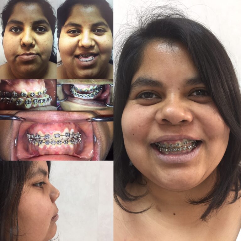 Cirugía Ortognática en Paciente con Fisura Labiopalatina