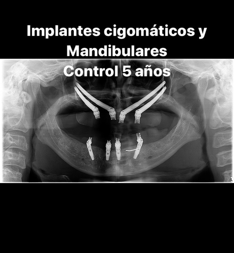 Implantes Cigomáticos y Mandibulares “all on four”