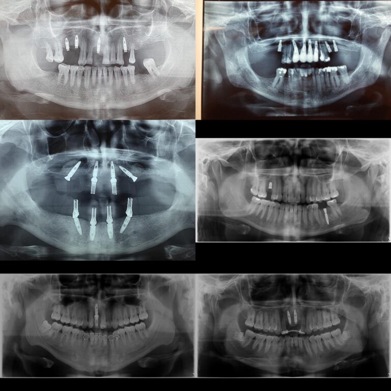 Implantes dentarios