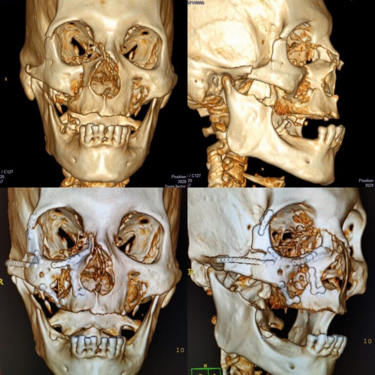 Reconstrucción de Trauma Facial