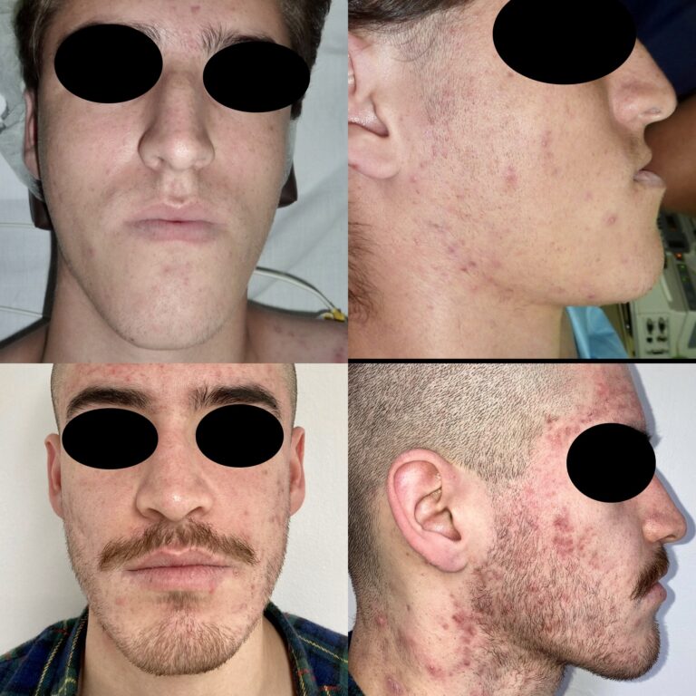 Cirugía  Ortognática bimaxilar con 2 años de evolución