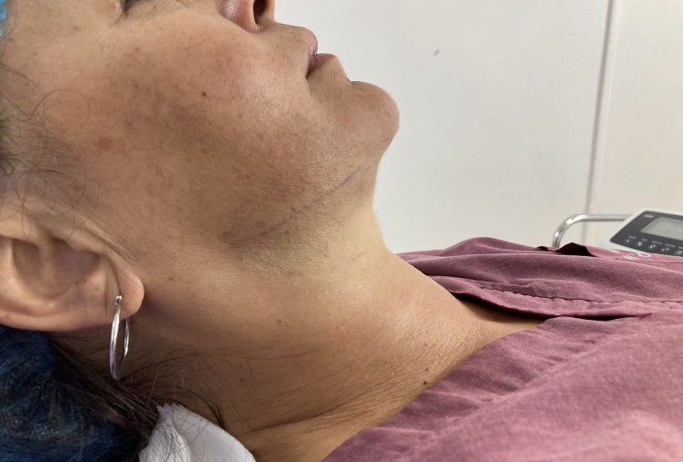 Lipoaspiración de papada